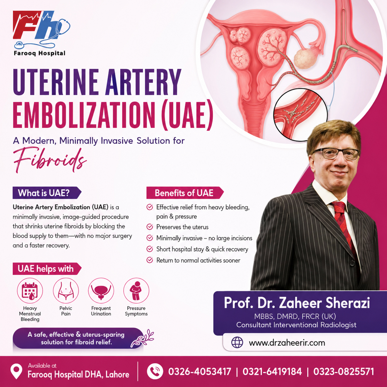 Uterine Artery Embolization (UAE) for Fibroids- professor dr zaheer sherazi - consultant interventional radiologist