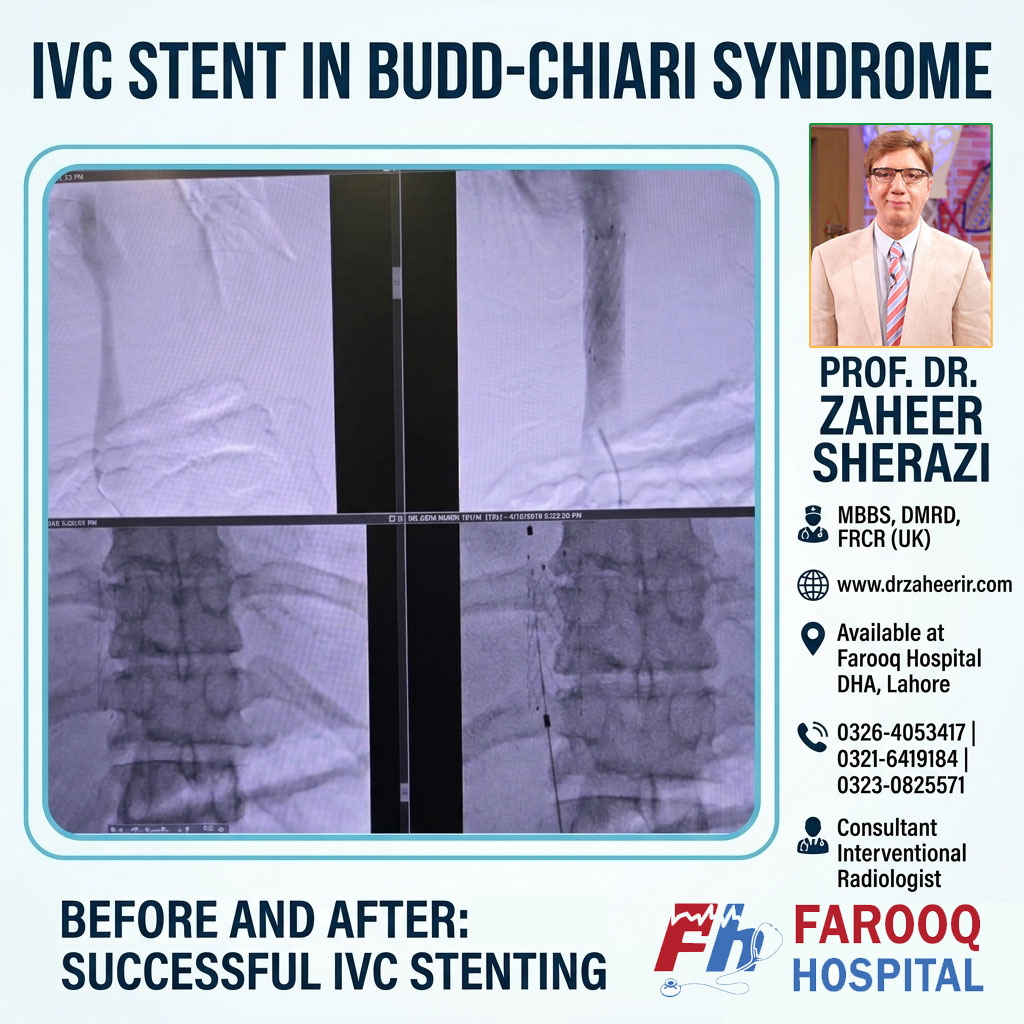 IVC stent in Budd Chiari Syndrome - Dr Zaheer Sherazi Interventional Radiologist